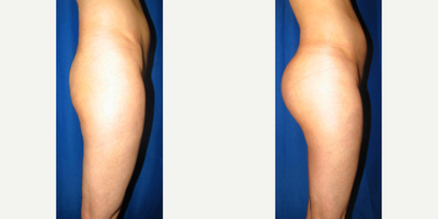 Woman treated with Butt Implants - Woman treated with Butt Implants