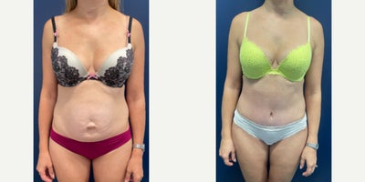 35-44 year old woman treated with Tummy Tuck, Liposuction, Power-Assisted Liposuction (PAL), Abdominal Etching, Umbilical Hernia - This beautiful mom of two underwent Tummy tuck with Liposuction, as well as Diastasis Recti Repair to create a flatter and more defined abdominal contour.  Her umbilical hernia was repaired and reconstructed at the same time creating a small innie belly button with minimal scarring on the outside.The scars will continue to fade over time.