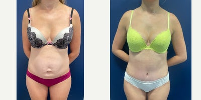 35-44 year old woman treated with Tummy Tuck, Liposuction, Power-Assisted Liposuction (PAL), Abdominal Etching, Umbilical Hernia - This beautiful mom of two underwent Tummy tuck with Liposuction, as well as Diastasis Recti Repair to create a flatter and more defined abdominal contour.  Her umbilical hernia was repaired and reconstructed at the same time creating a small innie belly button with minimal scarring on the outside.The scars will continue to fade over time.