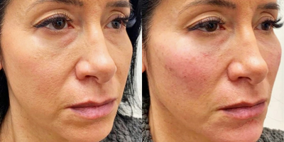 35-44 year old woman treated with Cheek Augmentation, Aquagold - Cheek and chin filler done by a certified nurse inejector with UFP Aesthetics
