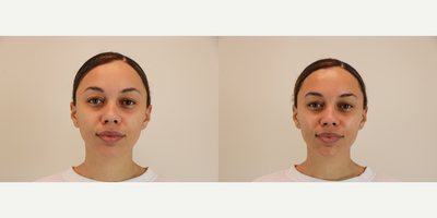 25-34 year old woman treated with Microdermabrasion - 25-34 year old woman treated with Microdermabrasion.