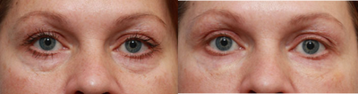 Belotero-under eyes - This patient was concerned about the baggy, hollowness under her eyes. She had a non-surgical procedure of 1cc of Restylane and 1cc of Belotero injected under her eyes.&nbsp;