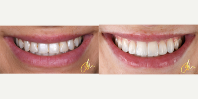 25-34 year old woman treated with Composite Veneers - Removal of old dental bonding and replaced with composite veneers