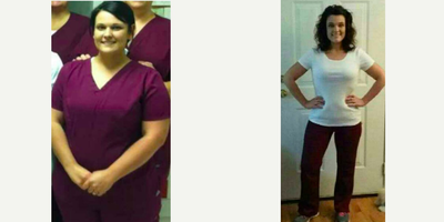 25-34 year old woman treated with Sleeve Gastrectomy - Sleeve Gastrectomy