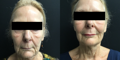 65-74 year old woman treated with TempSure Envi - Face tightening after 3 treatments. Non invasive radio frequency