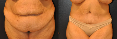 Woman treated with Tummy Tuck - Woman treated with Tummy Tuck