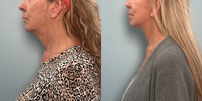 55-64 year old woman treated with Facelift - Patient treated with facelift.