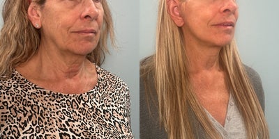 55-64 year old woman treated with Facelift - Patient treated with facelift.