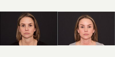 Woman treated with Facelift - Woman treated with Facelift.