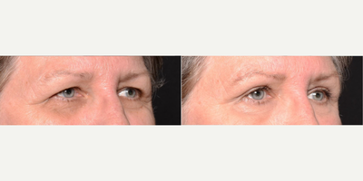 Woman treated with Eyelid Surgery - Woman treated with Eyelid Surgery.