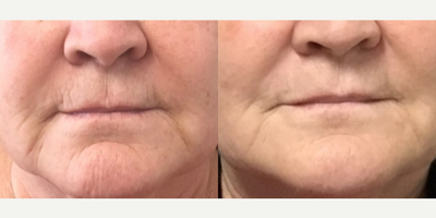 55-64 year old woman treated with Profound RF - Profound RF treatment around mouth. Photo taken two months after treatment. Results will continue to improve over next 4 months.