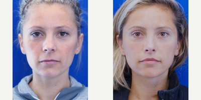 Woman treated with Lip Lift - Woman treated with Lip Lift after years of getting lip filler injection and not getting long term and full result. Patient underwent bullhorn lip lift which essentially raises the lip to show the fuller side of the upper lip.