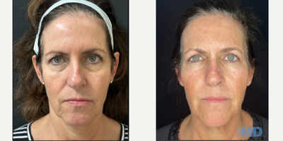 55-64 year old woman treated with NeoGen Plasma - NeoGen results of this lovely patient at Skin MD. 1 month post op -- we are so excited to see the continued improvement over the coming year!