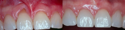 Gum Graft - 22 year old female with gum recession on upper central incisor. Pt had a gingival (gum) graft performed with a free gingival graft from her palate. The patient has beautiful results and the gum tissue matches perfectly and is healthy. She no longer has any recession