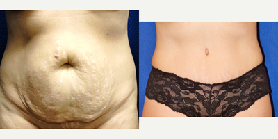 35-44 year old woman treated with Tummy Tuck - 42 year old woman4 children5'4140 pounds