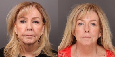 65-74 year old woman treated with Sylfirm X, Laser Resurfacing - 2 Sylfirm X Laser Treatments with Sarah Olsen. No filler or botox. 6 months post-treatment, age 65 years.
