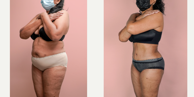 55-64 year old woman treated with Liposuction, Tummy Tuck - This lovely patient requested help in improving her shape and removing the sagging skin from her abdomen. She was able to turn back the clock and look 30 years younger with a combination of tummy tuck and 360 liposuction.