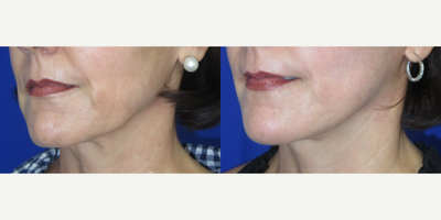 Chin Liposuction, Facelift, Neck Lift, CO2 Laser, Skin Tightening, Jaw Reduction - Woman treated with Chin Liposuction, Facelift, Neck Lift, CO2 Laser, Skin Tightening, Jaw Reduction