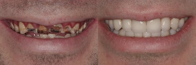 Full Mouth Reconstruction - 
	Full mouth reconstruction on a young male patient with sever dental decay. All teeth were treated. This patient was very happy to have his smile back.
