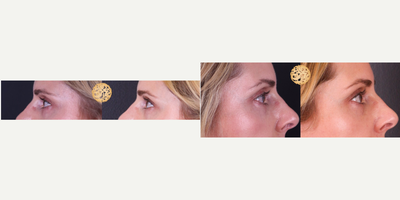 45-54 year old woman treated with Pelleve - Pelleve gives a youthful look by smoothing and removing crows feet and eye wrinkles.