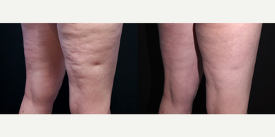 35-44 year old woman treated with Cellulaze - 40 year old female received Cellulaze to the thighs and buttocks; photos depict the patient's results 1 month post-op.