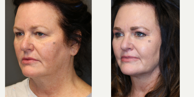 Enigmalift and fat transfer. - Enigmalift Browlift and eyelid lift with fat transfer and non-surgical neck tightening and lip lift.