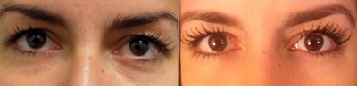 Latisse Results 26 Year Old Female at less than 8 Weeks - 
	Patient is wearing mascara in both the before and the after image.

