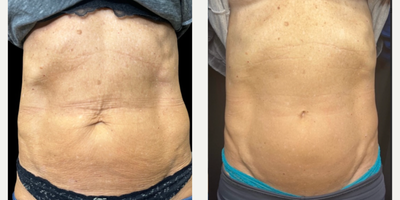 Patient treated with Sylfirm X - Patient treated with Sylfirm X
