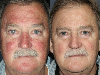 Photodynamic Therapy - 
	Photodynamic therapy for male.

