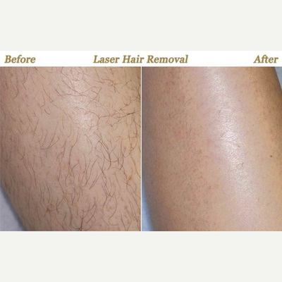 35-44 year old woman treated with Laser Hair Removal - Laser Hair Removal on Female's Leg