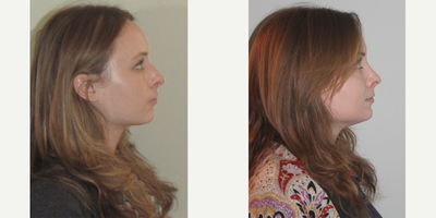 25-34 year old woman treated with Sinus Surgery - Female patient 4 months post op from turbinate reduction and septoplasty surgery.
