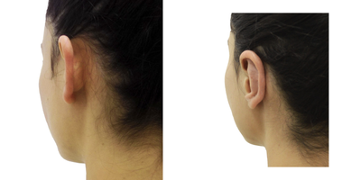 18-24 year old woman treated with Ear Surgery - At approximately six years of age, the development of the auricular pavilions has been reached, which indicates that surgery can be performed, always taking into account the authorization of the parents or legal guardians.