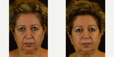 NovaLift - Non-Surgical Rejuvenation with PDO Threads and Microcannula Fillers - Demonstrating the amazing results after one session of non-surgical, office-based injections. Procedures performed were Novathreads (PDO threads) to lift the midface and lower third. Once the lift was performed, it took less filler to achieve revolumization of the cheeks. We injected Restylane Lyft into the cheeks and Restylane to the tear troughs. After the lower third / jowls were lifted with the threads, we injected Restylane into the marionette / corner of mouth area with the bruiseless microcannula technique. Results are expected to last at least 6 months possibly up to one year.