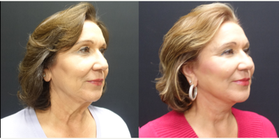 65-74 year old woman treated with SMAS Facelift - The patient underwent a high lateral SMAS face and necklift. The SMAS elevation supports the facelift so that their is minimal tension on the skin and enhance the possible longevity of the face and necklift. Along with the face and necklift she also had fat transfer to the face. Fat was transferred tough out the face and temples to restore the volume she has lost over time as we age. The combination of tightening and filling of the face gives her a much more youthful but natural appearance. This pictures show her two month result.