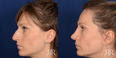 Woman treated with Rhinoplasty - Woman treated with Rhinoplasty