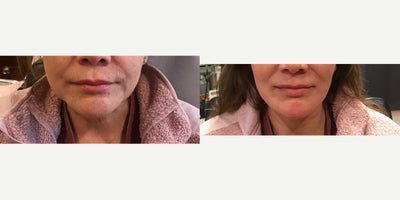 45-54 year old woman treated with Skin Rejuvenation - Attiva Skin Rejuvenation and tightening Face and neck