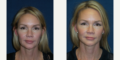 45-54 year old woman treated with Cheek Lift - 47 year old female, 3 months post-op. Cheeklift