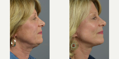 Woman treated with Facelift - These results from a recent facelift, blepharoplasty with fat repositioning case performed by facial specialists, Dr. James C. Marotta.