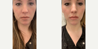 Woman treated with Dysport, Botox - Woman treated with Dysport, Botox