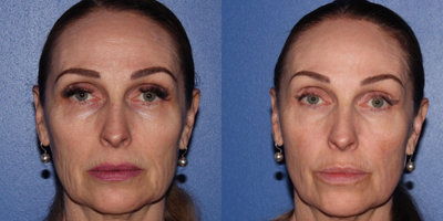 55-64 year old woman treated with ProFractional Laser - Patient was treated with Profractional full face and 1 follow up Clear and brilliant 5 months later