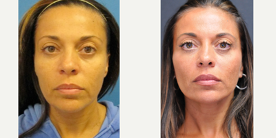 35-44 year old female treated with Lower Facelift - This patient came to me on a mission, which was to fight the aging process. Although noninvasive and minimally invasive procedures are appropriate in this situation, she made it clear that she was not looking for fillers or botox. She wanted her face back to where it was a few years ago. I created a treatment plan which involved performing a lower facelift under local anesthesia. Although she had some mild-moderate swelling after the procedure, she was out in public within 3 days. Her bruising was almost nonexistent. Her after picture is about 12 months from the time of her procedure.