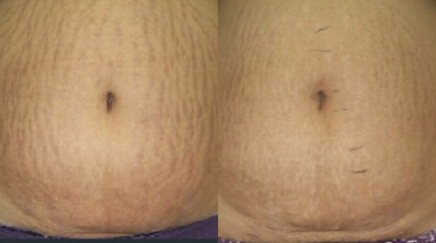 Venus Viva - Before and After 4 Treatments. &nbsp;Photos provided courtesy of Venus Concept, performed by Megha Joy Shah, MD.