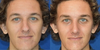 Man treated with Rhinoplasty - Rhinoplasty