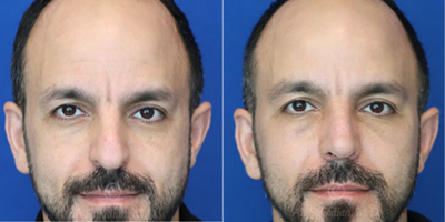 Man treated with Rhinoplasty - Rhinoplasty