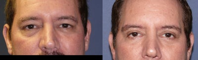 4 lid blepharoplasty - 
	He had it all. Loose skin, fat pad herniations and a droopy corner to the eye. We did it all: upper eyelids with skin and fat removal, lower eyelids with skin and fat removal and lateral canthoplasty to support and lift the corner of the eye.