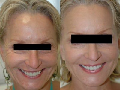 Dysport Injections Before and After Photos - 
	Dysport (Botox) injections to fix crow&#39;s feet lines at the outer eyes. Before and after pictures for Dysport, the competitor to Botox.
