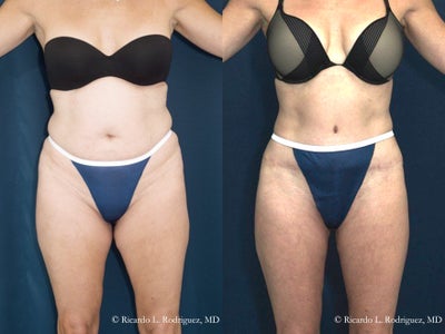 Mini Tummy Tuck - 	Dermatolipectomy is a procedure that takes out skin, but does not tighten the muscle. It benefits most slender women who have wrinkly or excess skin, but good muscle tone.