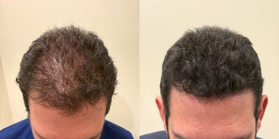 35-44 year old man treated with Scalp Micropigmentation - before and after SMP treatment for a Male patient desiring more fullness to the crown and mid scalp.
