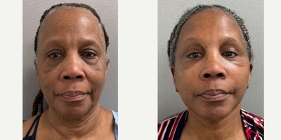 73 yo woman s/p  Deep Plane Facelift performed in our on site AAAA certfied operating suite - 73 yo woman s/p Deep Plane Facelift performed in our on site AAAA certfied operating suite