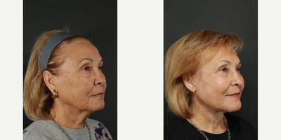 Woman treated with Facelift, Neck Lift - Woman treated with Facelift, Neck Lift